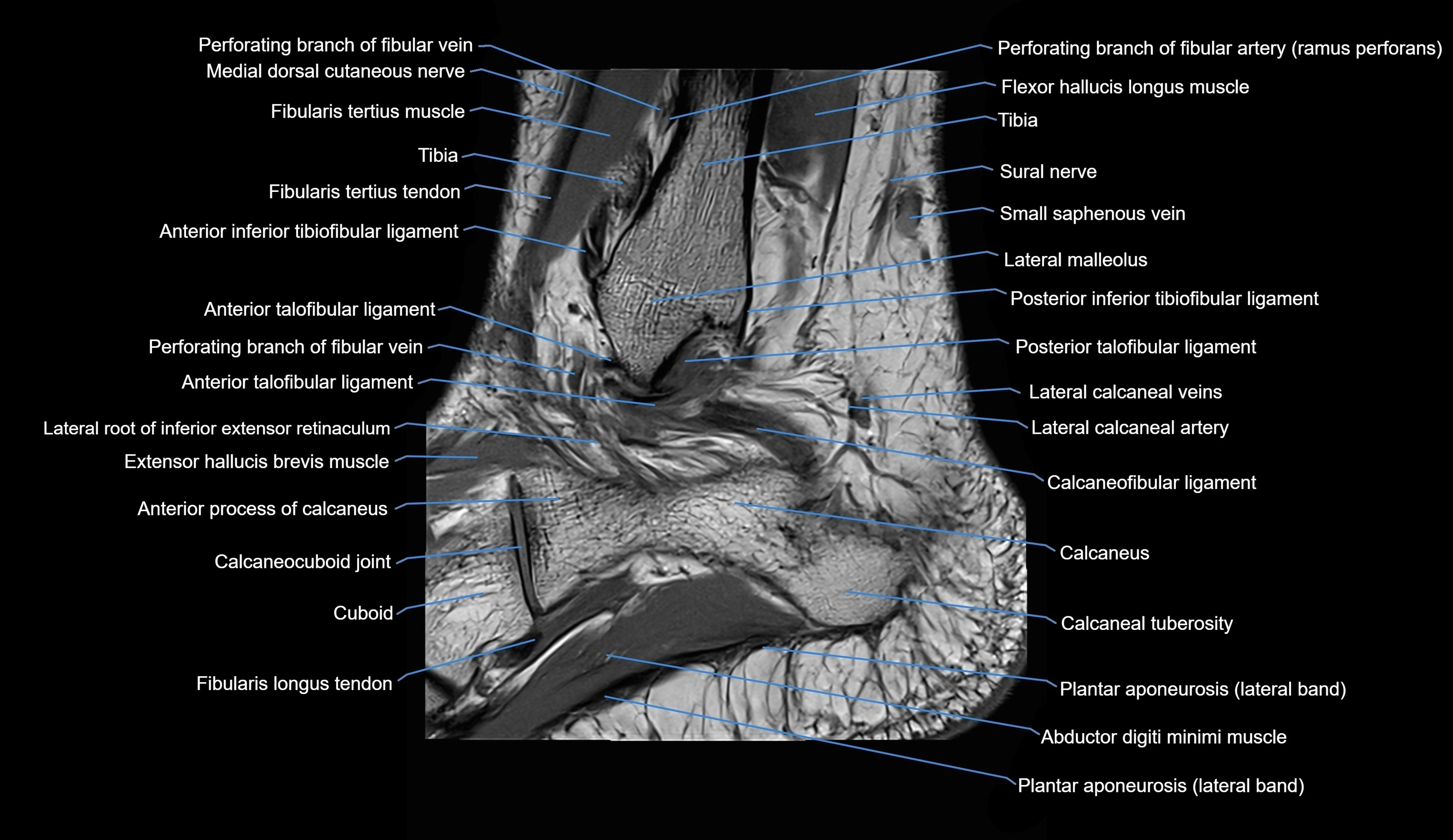 MRI Ankle sagittal cross sectional anatomy 3T  radiology  image-img-00001-00028.webp